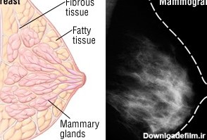 شکل و ظاهر سرطان سینه در ماموگرافی | دکتر بهزاد رحمانی