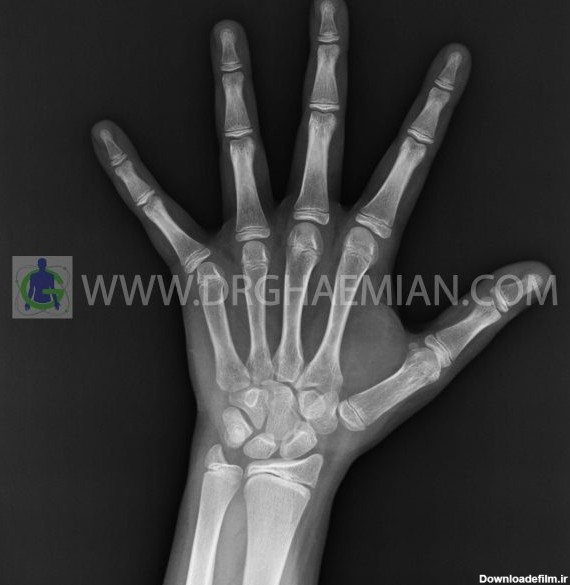 رادیولوژی دست - دکتر قائمیان | مرکز تصویر برداری پزشکی دکتر قائمیان