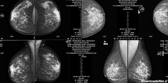 ماموگرافی و تفسیر جواب آن | عوارض ماموگرافی | یک زن
