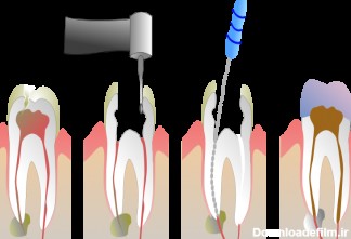 درمان ریشه دندان یا عصب کشی دندان