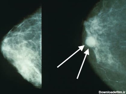 تشخیص بافت یا توده های سرطانی سینه با ماموگرافی - درمانکده