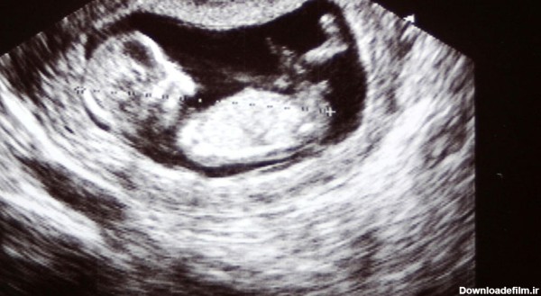 تفاوت جنین دختر و پسر در سونوگرافی هفته 12