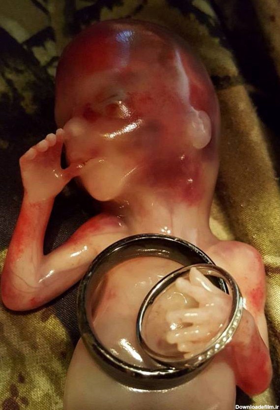 ماجرای دلخراش سقط جنین 14 هفته ای (عکس)