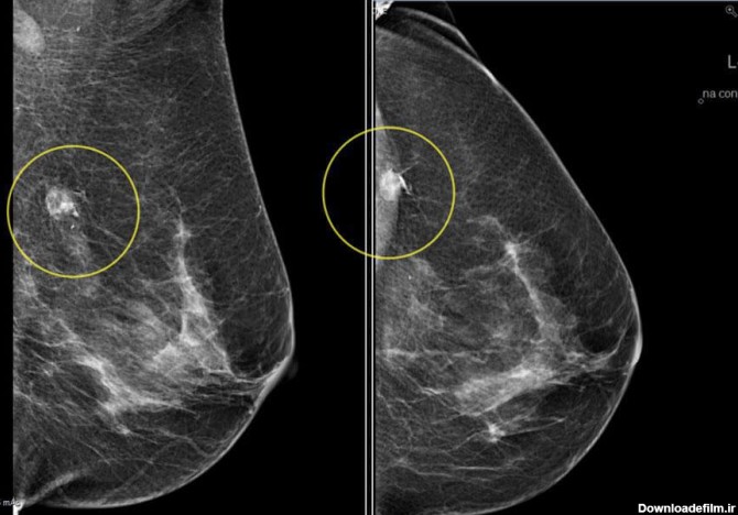 ماموگرافی | اسکن طب