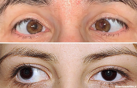 استرابیسم یا لوچی چشم چیست و چگونه درمان می‌شود؟