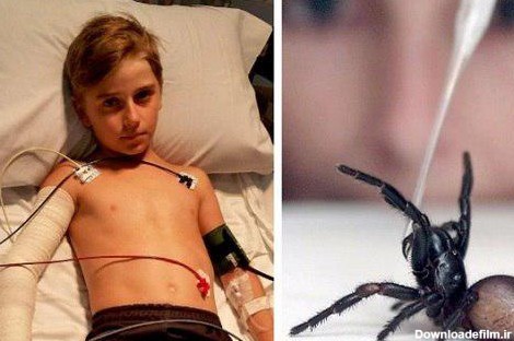 پسری که وحشتناک ترین عنکبوت دنیا نیشش زد + عکس | سایت انتخاب