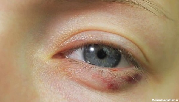 13 روش خانگی درمان ورم ، خون مردگی و کبودی چشم در اثر ضربه