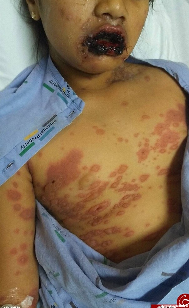 بیماری نادری که کودک 9 ساله را تبدیل به زامبی کرد (+ عکس 16+)