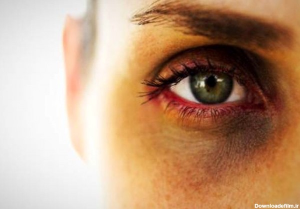 ۱۲ علت اصلی کبودی و سیاهی دور چشم و ۱۶ روش درمان خانگی آن