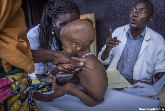 فرارو | (تصاویر) بحران سوء‌تغذیه کودکان افریقای‌مرکزی