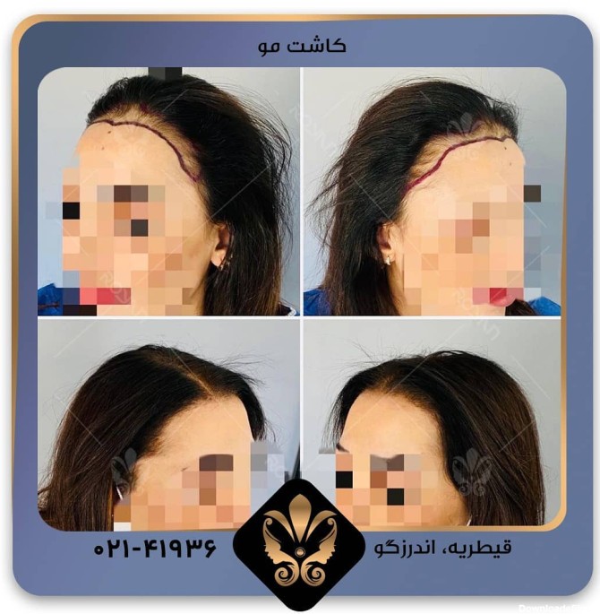 کاشت مو برای پیشانی های بلند در زنان و مردان [عکس قبل و بعد]