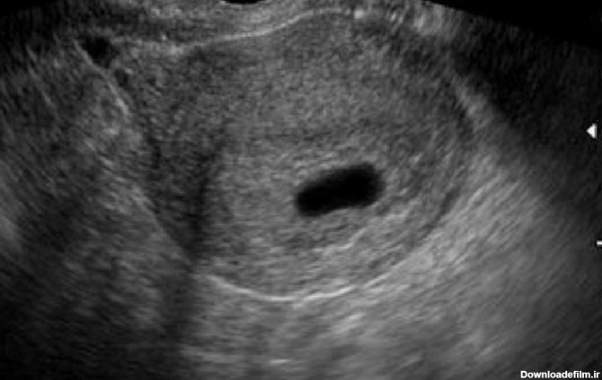 در هفته پنجم حاملگی جنین در سونوگرافی دیده نمی‌شود. اما همانطور که در تصویر می‌بینید کیسه حاملگی قابل مشاهده است.