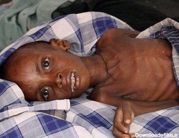 مردم یمن در لبه پرتگاه مرگ/ کودکانی که بخاطر قحطی پوست آنها به ...