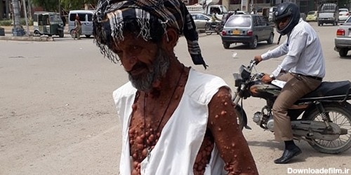 بیماری عجیب مرد حبابی+تصاویر | خبرگزاری فارس