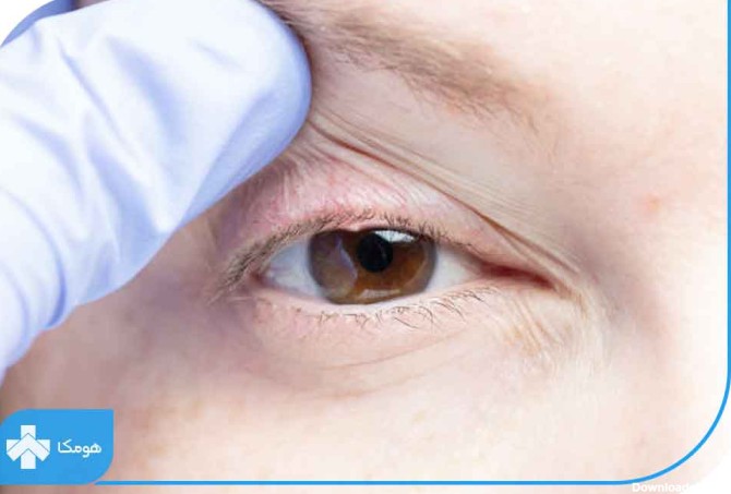 کیست چشم + انواع کیست‌های چشمی و پلک چشم | مجله هومکا