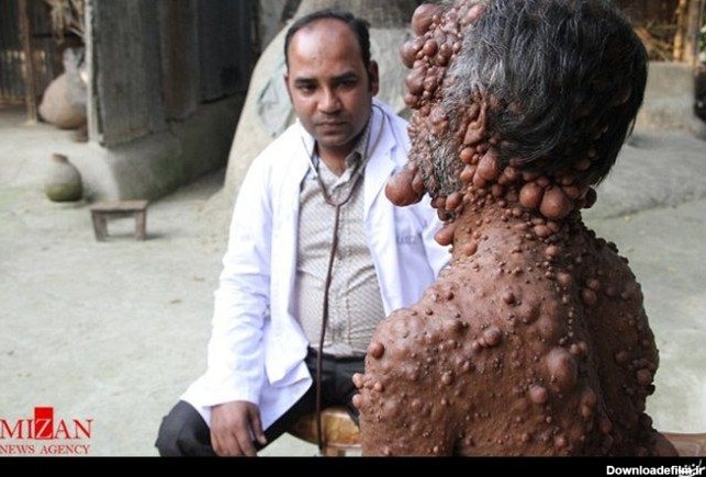 مرد حُبابی از بیماری ژنتیکی رنج می‌برد (۱۶+) +عکس