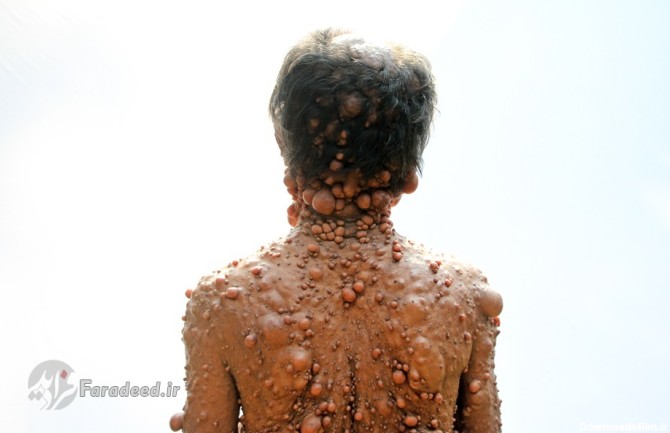 تصاویر+16/ تومورهای حبابی مرد بنگلادشی