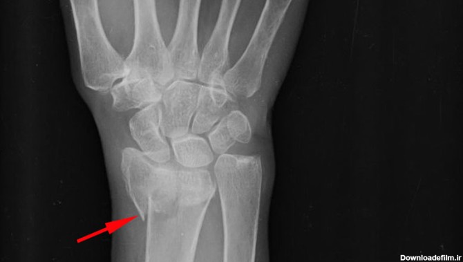 شکستگی مچ دست (Colles' fracture) - فیزیوتراپی تخصصی افق روشن ...