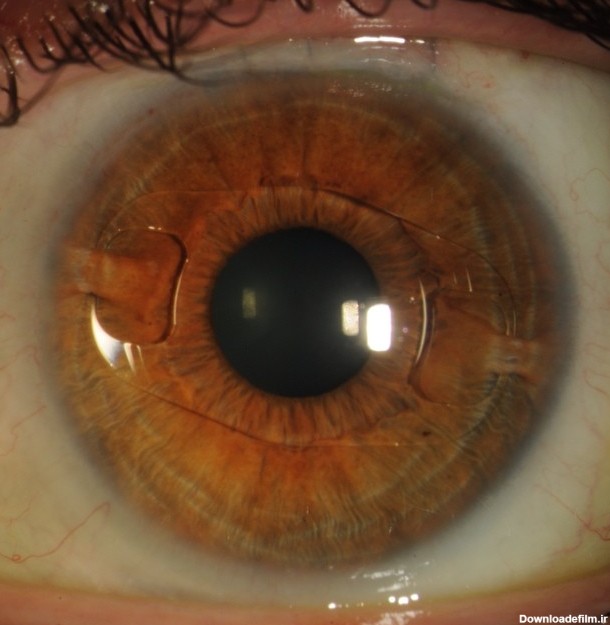 انواع لنز داخل چشمی | کلینیک چشمخانه