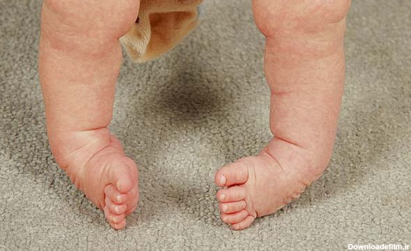 پاهای نوزادان را در سنین پایین باید درمان کرد.