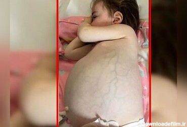 زایمان عجیب دختر 7 ماهه ! + عکس +16/وجود جنین زنده در بدن کودک