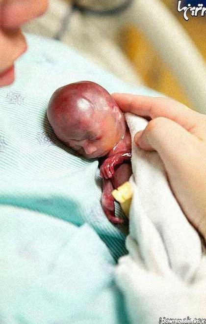 به دنیا آمدن جنین | عکس های تولد جنین شش ماهه