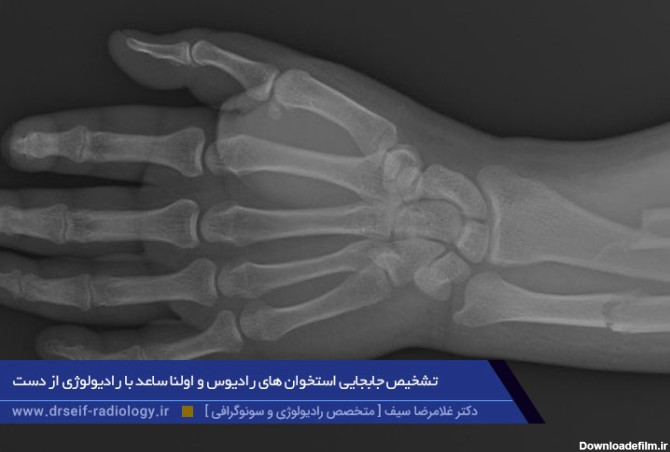 تشخیص جابجایی استخوان های دست با رادیولوژی