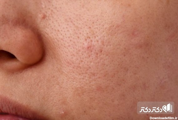 علت جوش سرسیاه روی بینی و پوست چیست وچگونه از بین می‌رود؟