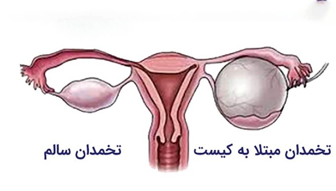 روش‌های پیشگیری و درمان کیست تخمدان
