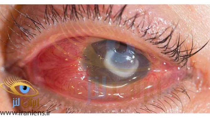علائم خرابی لنز چشم چیست؟ چه عواملی باعث عفونت چشم می شود؟ | ایران لنز
