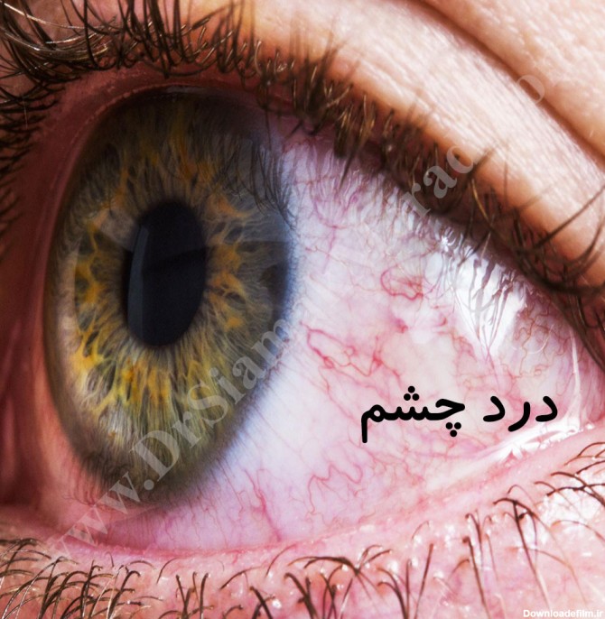 چشم درد و علل و راه های درمان آن - دکتر سیامک مرادی، فوق تخصص درد