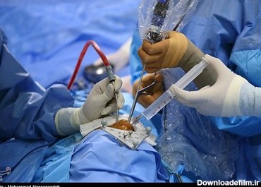 عمل جراحی برداشتن تومور هیپوفیز