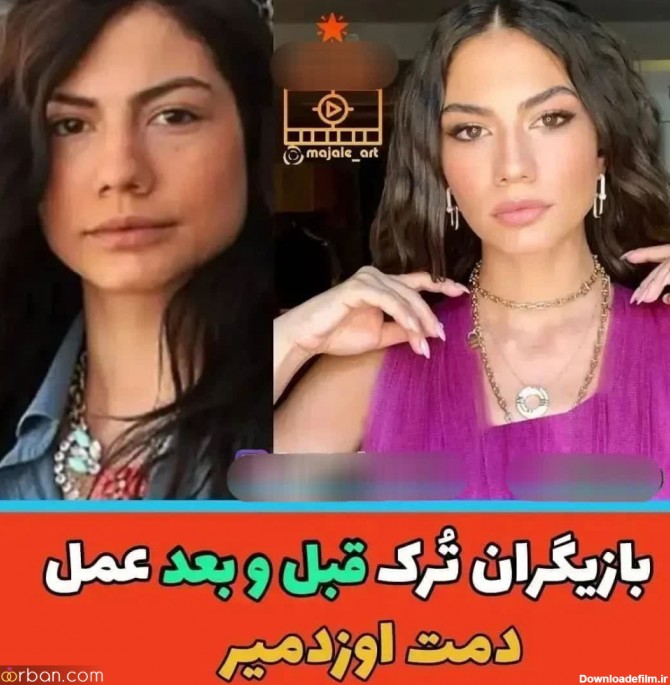 چهره بازیگران مطرح ترکیه ای قبل و بعد از عمل های متعدد (+عکس ...