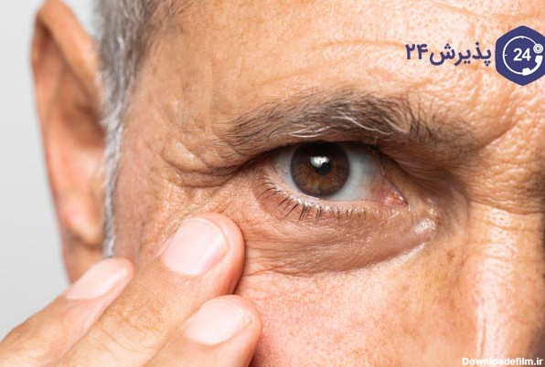 پیر چشمی، علل، علائم و راه های پیشگیری و درمان آن | پذیرش۲۴