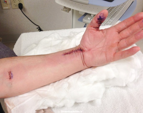 عوارض عمل تاندون دست پس از جراحی کاردرمانی کلینیک کاردرمانی مهراد