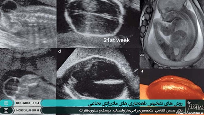 ناهنجاری های مادرزادی نخاعی و ستون فقرات | دکتر محسن القاسی