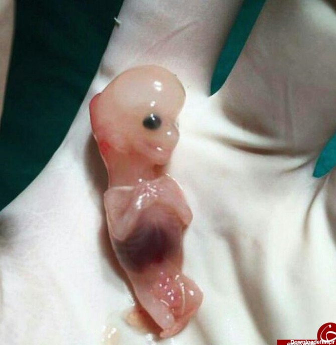 تصویر جنین سقط شده 7 هفته ای که همه را شوکه کرد+ عکس