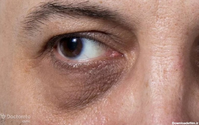 علت سیاهی دور چشم چیست و چگونه آن را درمان کنیم؟ – مجله ...