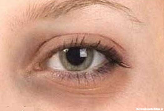 دلیل تیرگی دور چشم چیست؟ / درمان سیاهی دور چشم از نظر طب سنتی