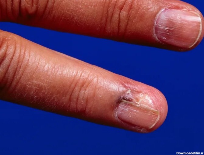 خطی روی ناخن که نشانه یک سرطان تهاجمی پوست بود - همشهری آنلاین
