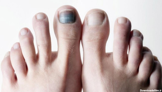 سیاهی ناخن پا ؛ دلایل، علائم و درمان آن - درمانکده