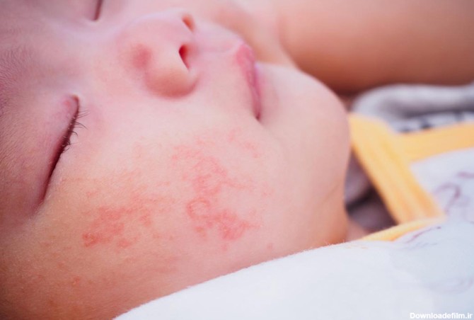 حساسیت پوستی اگزما در کودکان و نوزادان