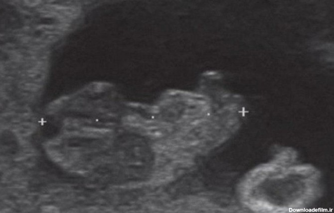سونوگرافی جنین در هفته نهم بارداری