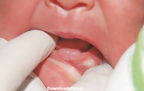 کیست های لثه و دندان در کودکان