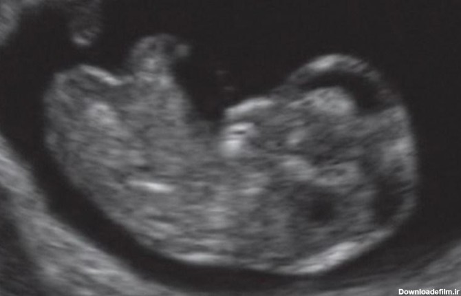 سونوگرافی جنین در هفته دهم بارداری