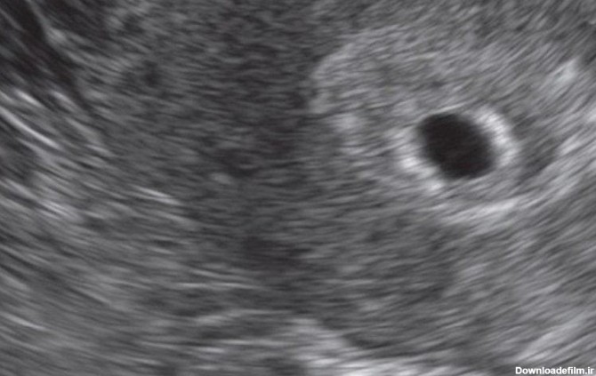 سونوگرافی جنین در هفته پنجم بارداری