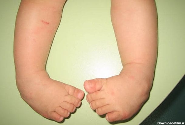 اختلال مادرزادی که در کمین پسران است+ تشخیص و درمان