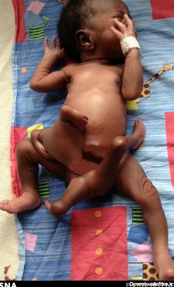 تولد نوزادی با 8 دست و پا! (+عکس)