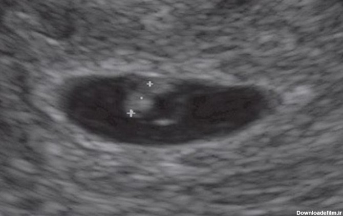سونوگرافی جنین در هفته ششم بارداری