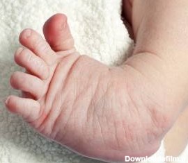 11 نوع مشکل ارتوپدی شایع در پای نوزادان + علائم و درمان